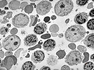 M,71y. | blood - blastic elements M,71y. | blood - blastic elements